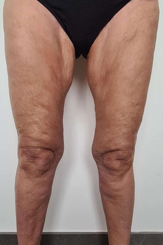 Cryolipolyse amincissante et traitement anti cellulite à Sainte-Maxime
