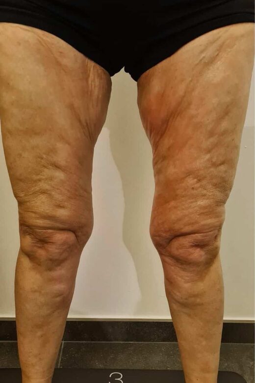 Cryolipolyse amincissante et traitement anti cellulite à Sainte-Maxime