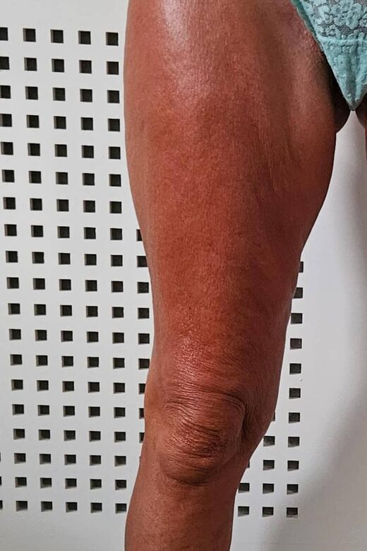 Cryolipolyse amincissante et traitement anti cellulite à Sainte-Maxime