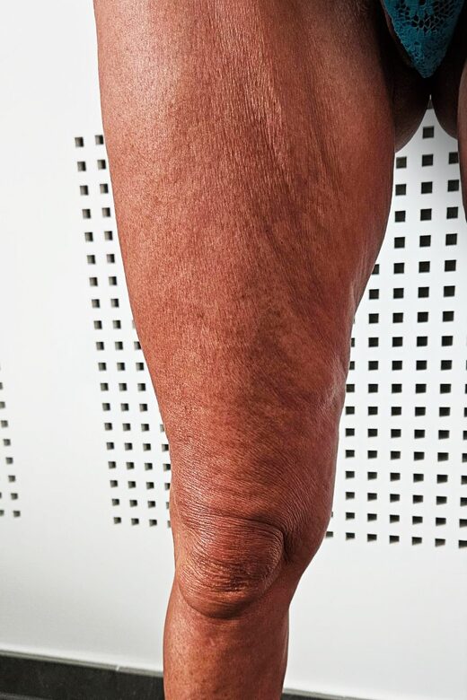 Cryolipolyse amincissante et traitement anti cellulite à Sainte-Maxime