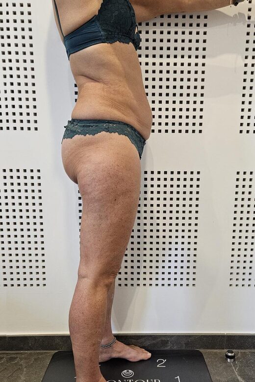 Cryolipolyse amincissante et traitement anti cellulite à Sainte-Maxime
