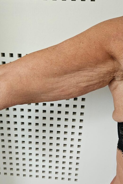 Cryolipolyse amincissante et traitement anti cellulite à Sainte-Maxime
