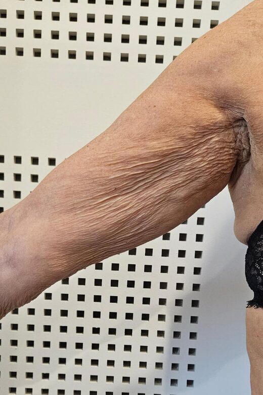 Cryolipolyse amincissante et traitement anti cellulite à Sainte-Maxime