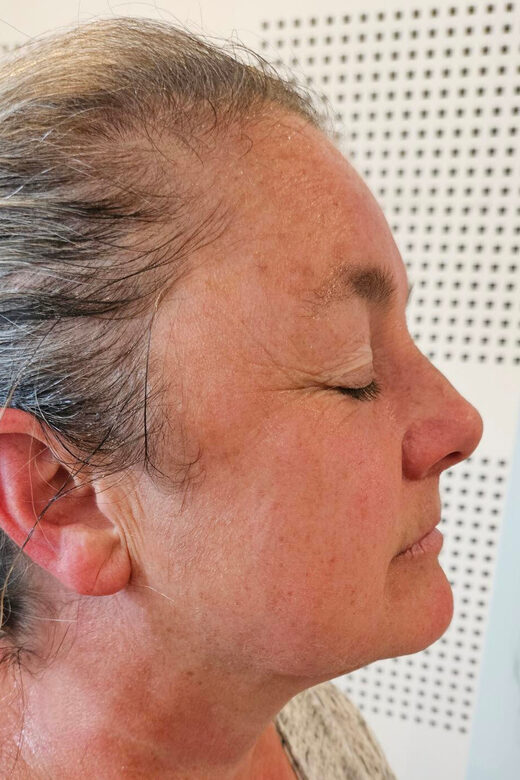 Radiofréquence : traitement anti-ride, la solution anti-âge à Sainte-Maxime dans le Var