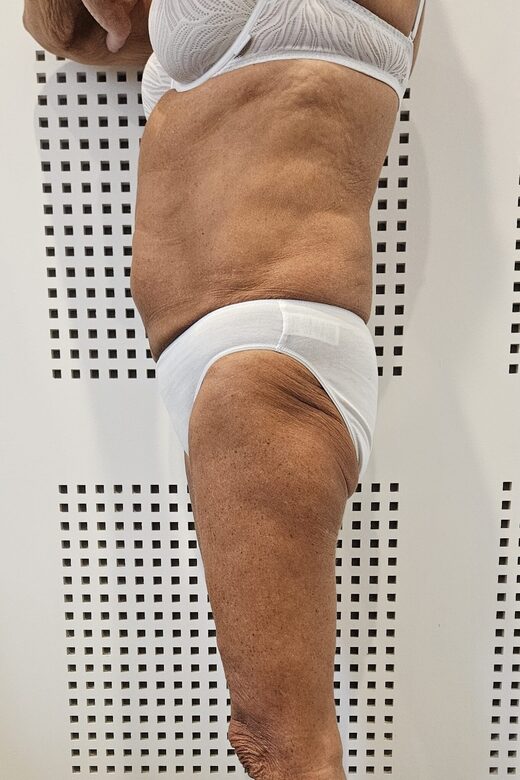 Cryolipolyse amincissante et traitement anti cellulite à Sainte-Maxime