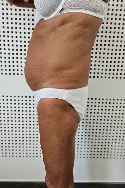 Cryolipolyse amincissante et traitement anti cellulite à Sainte-Maxime