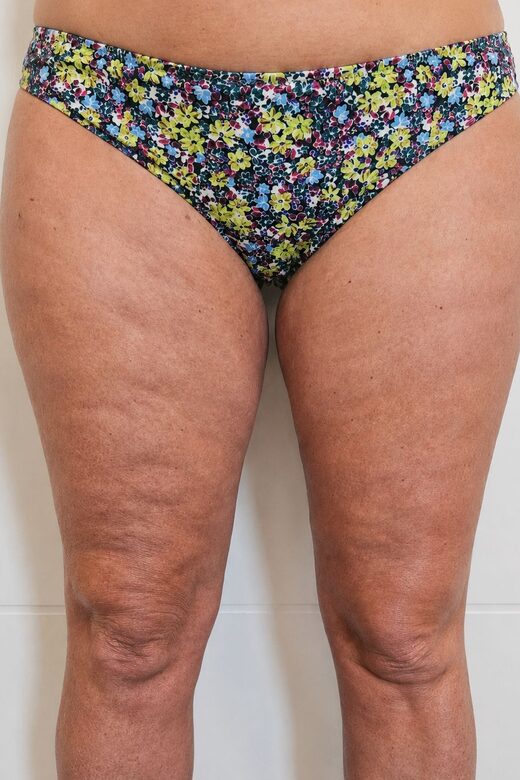Cryolipolyse amincissante et traitement anti cellulite à Sainte-Maxime