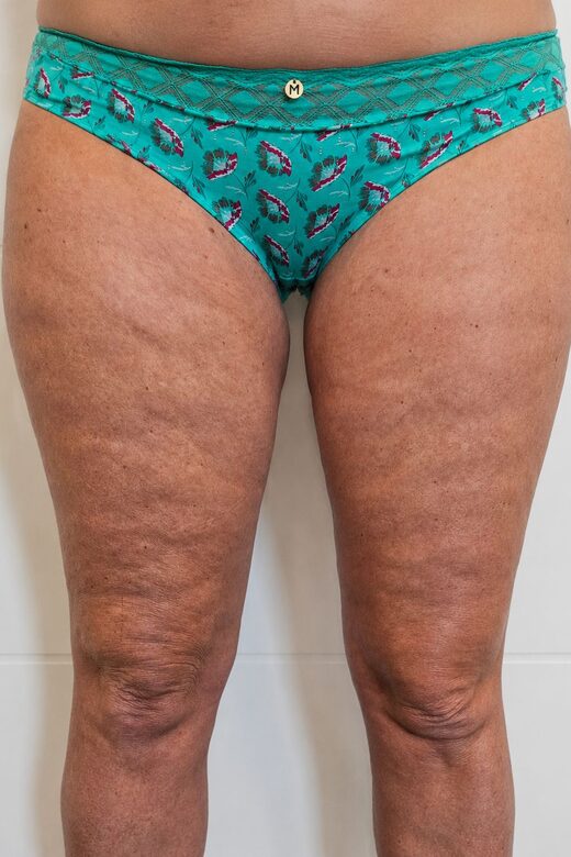Cryolipolyse amincissante et traitement anti cellulite à Sainte-Maxime